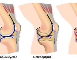 Почему болит колено при сгибании и разгибании: причины